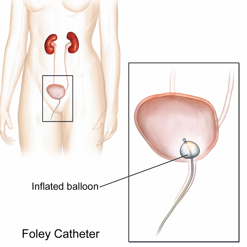 Illustration showing placement of Foley catheter in bladder