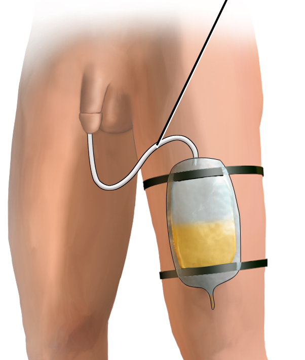 Illustration showing Indwelling Catheter Attached to Leg Bag on male patient