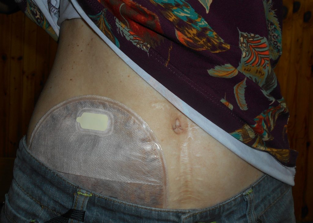 Photo showing Ileostomy Appliance with a Pouch Attached