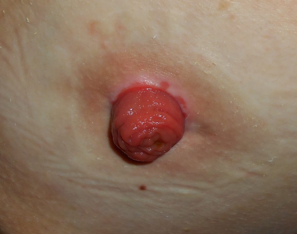 Photo showing closeup of a ileostomy stoma