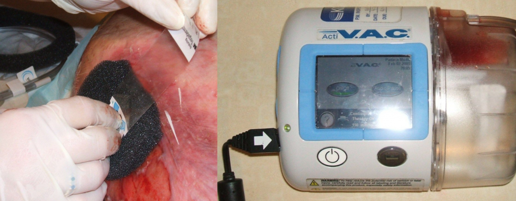 Photo showing wound vac and application on patient