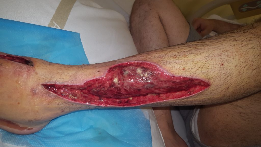 Photo showing wound debridement on lower leg