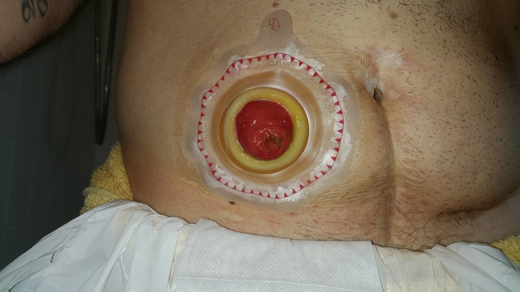 Photo showing Stoma with a Wafer Barrier