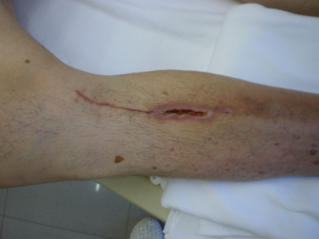 Photo showing closeup of post operational periwound
