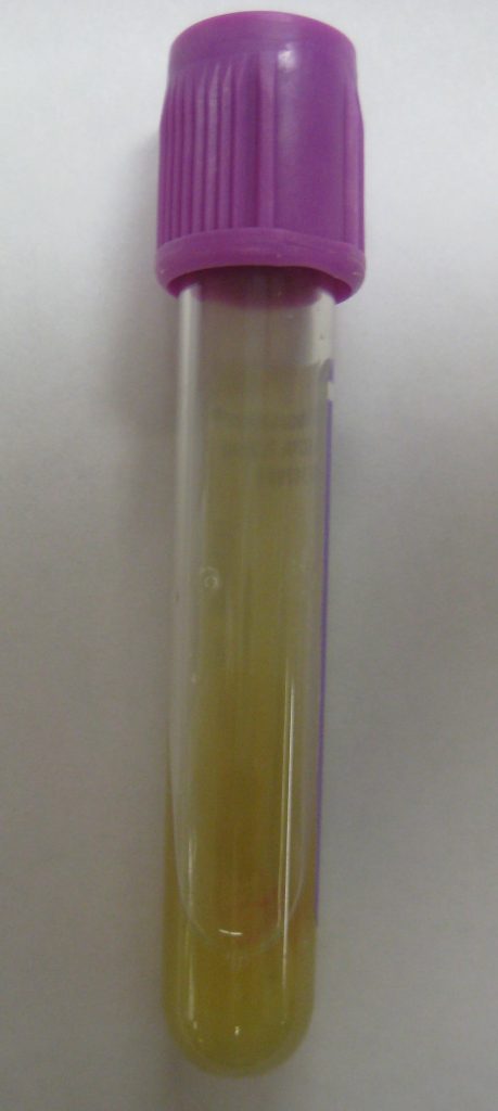 Photo showing vial of purulent drainage