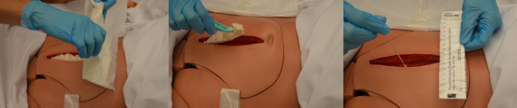Photo showing the process of removing dressings and wound assessment of a simulated wound