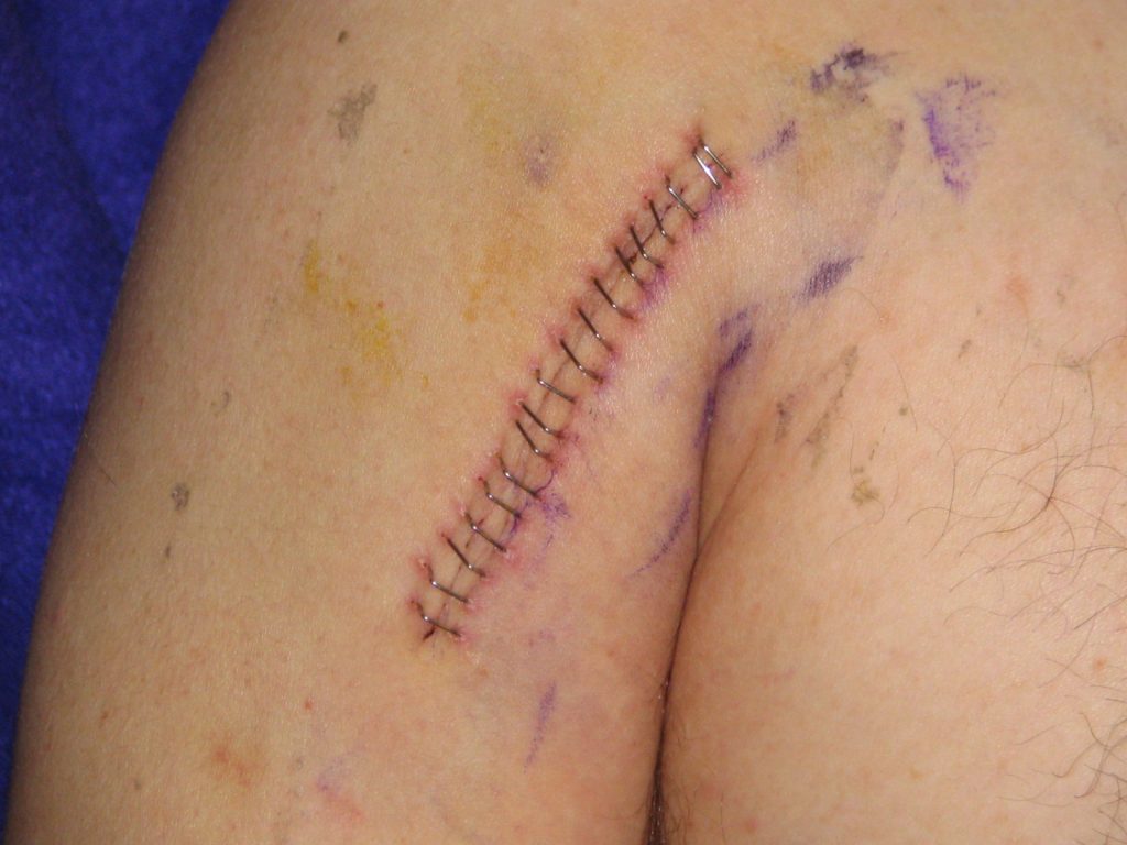 Photo showing a stapled, healing wound