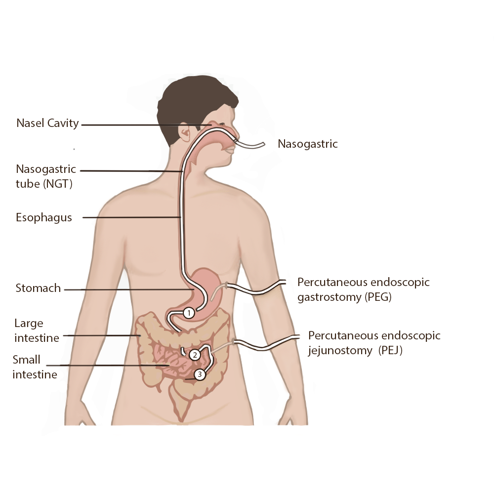 Illustration showing Types and Placement of Enteral Tubes
