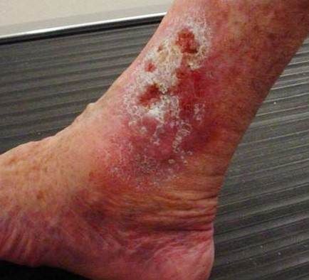 Photo showing closeup of skin damage on lower leg due to venous ulcer