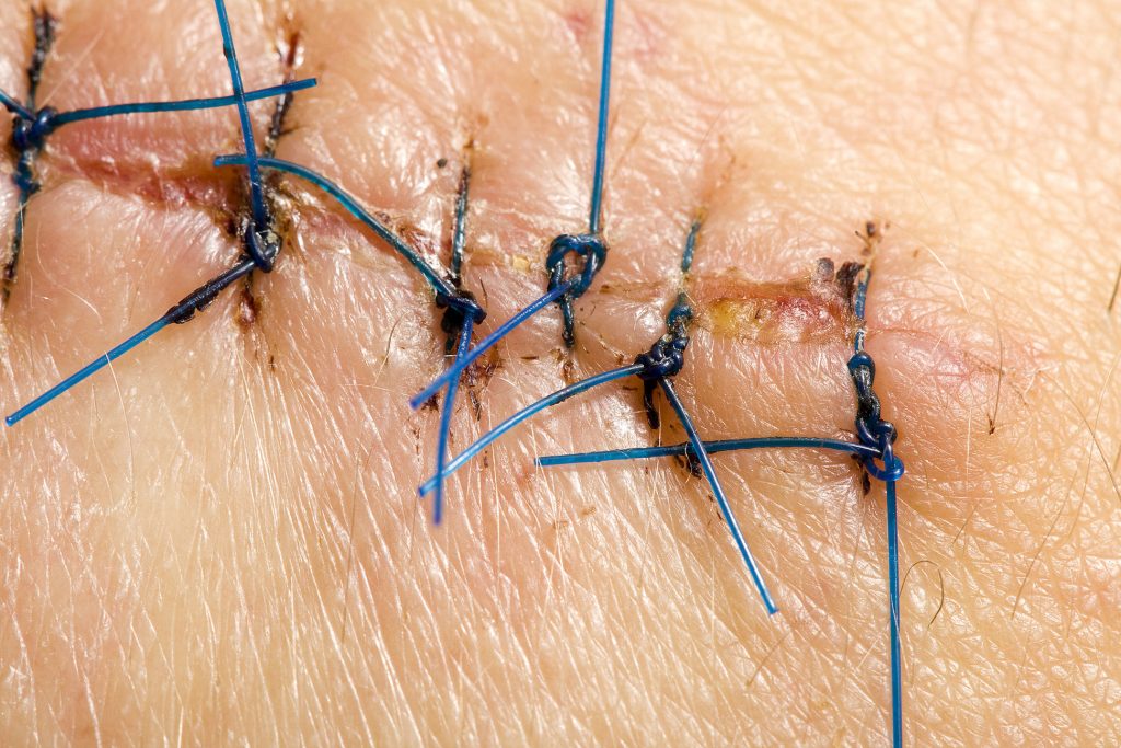 Photo showing closeup of healing sutures
