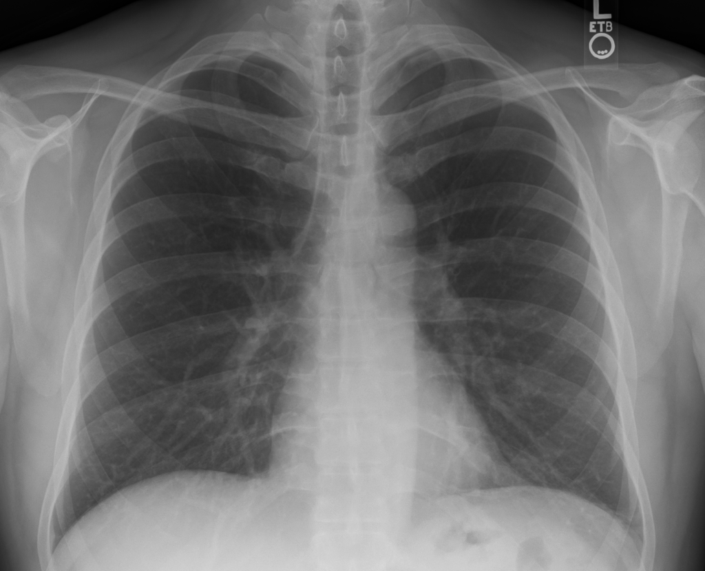 Image of a Chest X-ray
