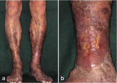 Photo showing Stasis Dermatitis Due to Venous Insufficiency