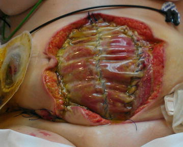 Photo showing dehicence on abdominal wound