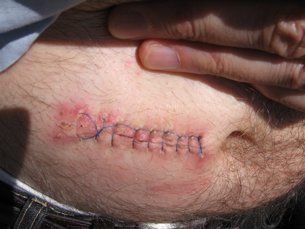 Photo showing Primary Intention Wound Healing