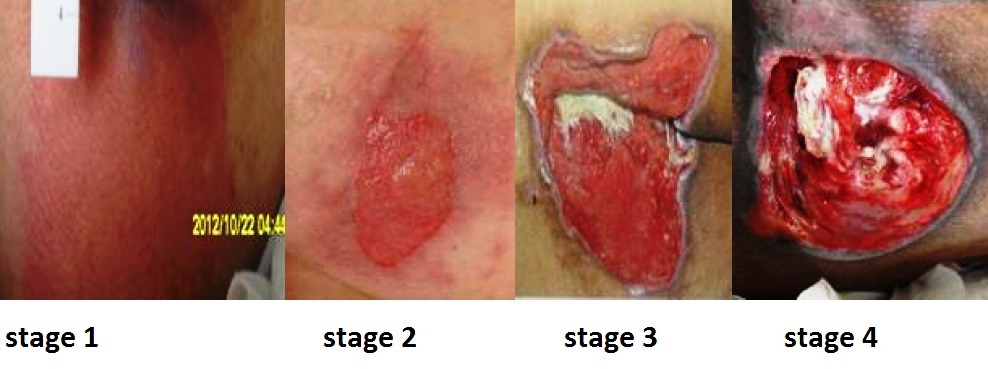 Photo showing Four Stages of Pressure Injuries