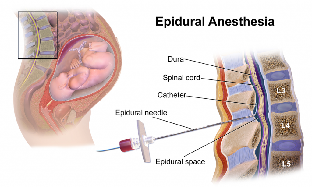 Illustration of epidural anesthesia