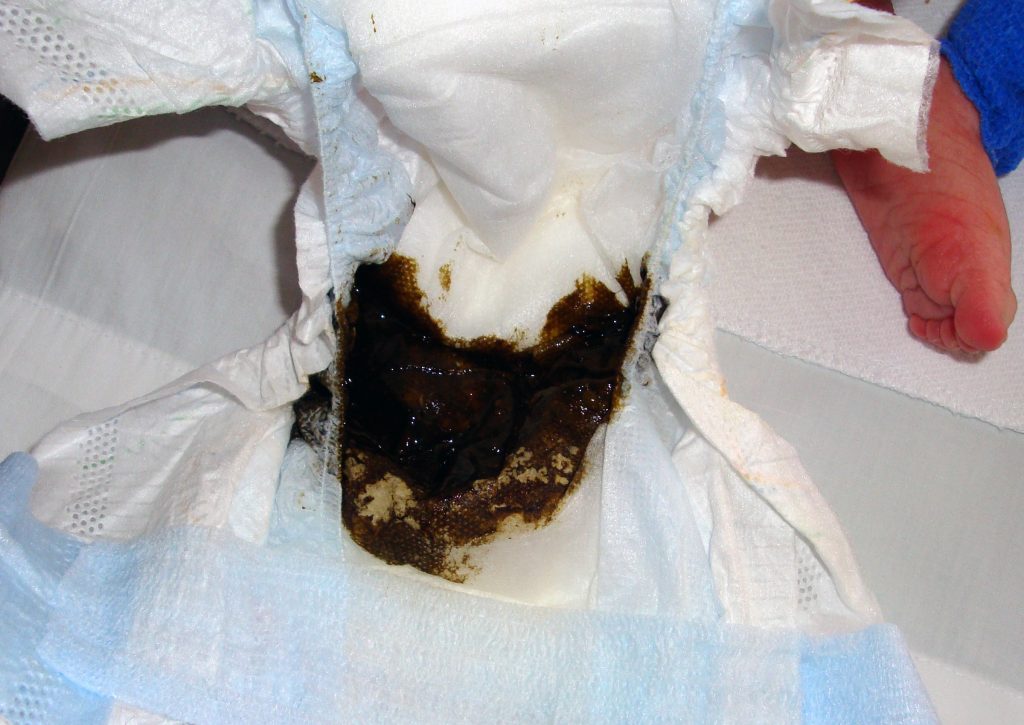 Image showing meconium in a diaper