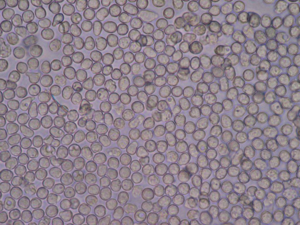 Image showing micrograph of Urinalysis Demonstrating White Blood Cells