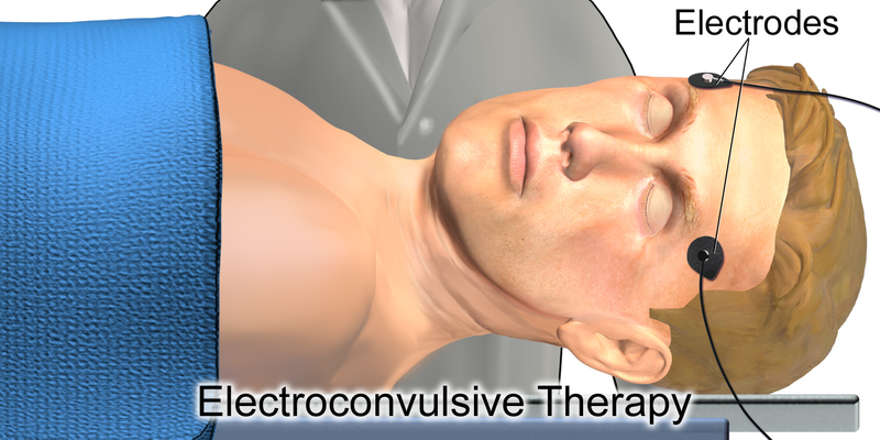 Illustration showing placement of electrodes on patient for electroconvulsive therapy