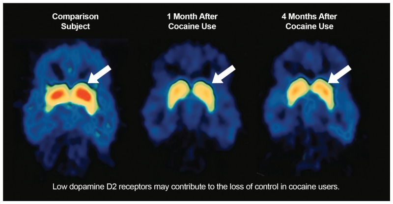 Image showing Decreased Dopamine Receptors in an Individual With a Cocaine Addiction across several months of use
