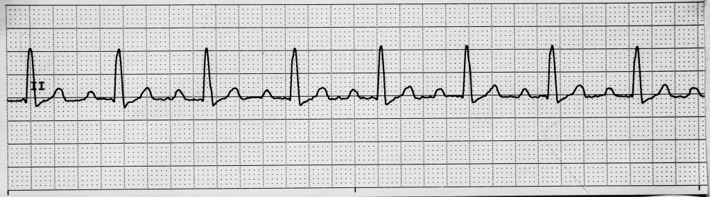 Image showing a first degree heart block on an ECG