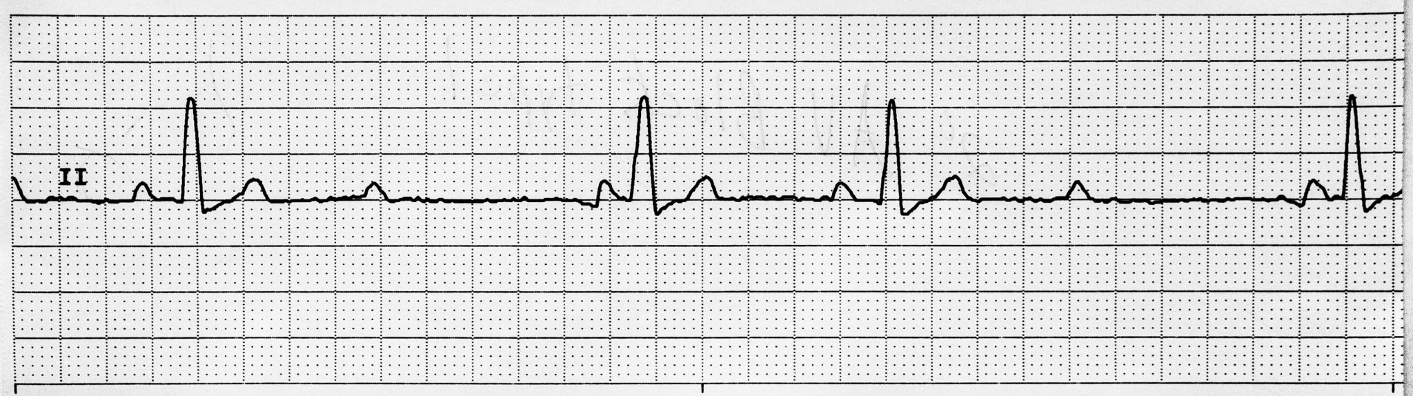 Appendix of Rhythm Strips – Nursing Advanced Skills