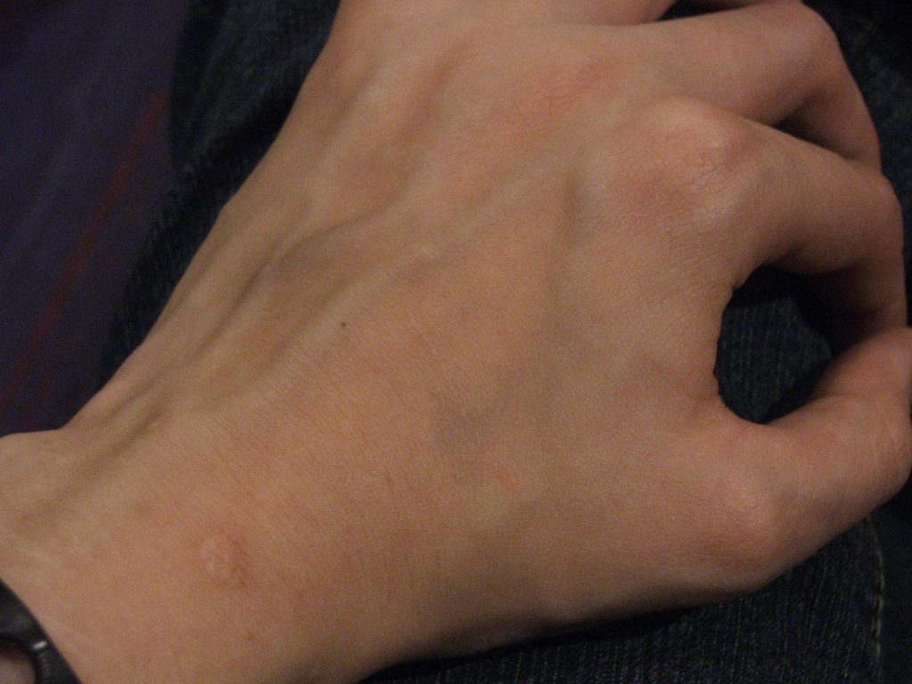 Photo showing a close up of veins in a hand