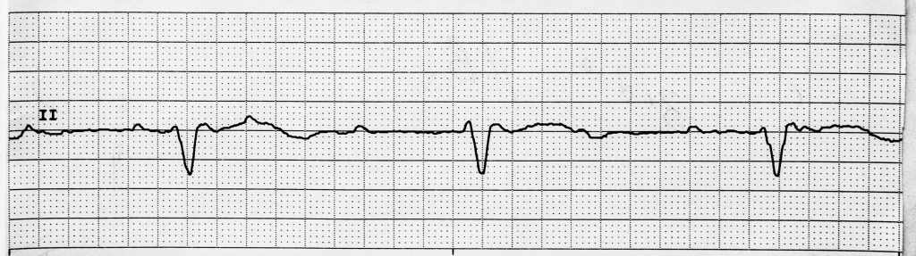 Image showing a third degree heart block on an ECG