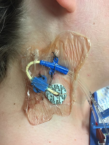 Photo showing closeup of a central line located on a patient's neck
