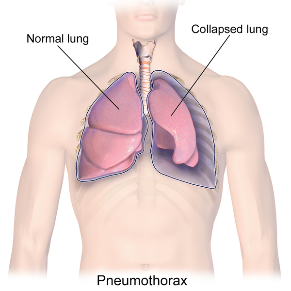 Illustration showing the Pneumothorax, with textual labels