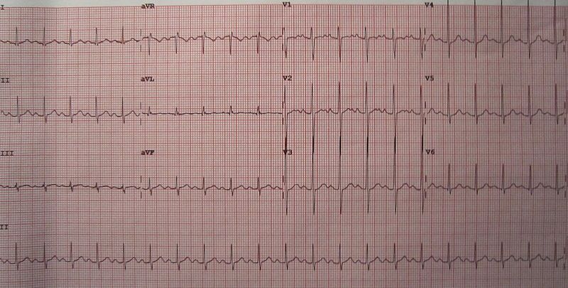 Image showing a 12-Lead ECG