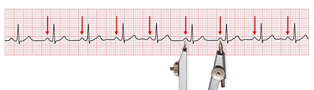 Image of ecg strip, with arrows and caliper tip, to demonstrated Assessing the P to P Distance