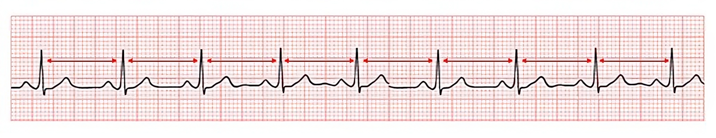Image of ecg strip, with arrows, to demonstrate Assessing the R to R Distance