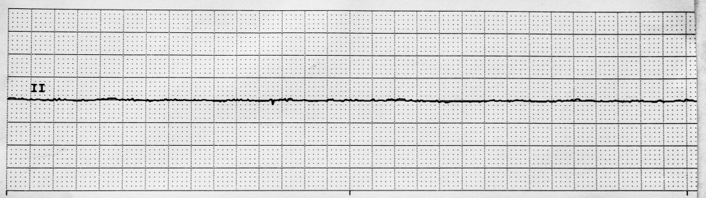 Image of an asystole pattern on an ECG