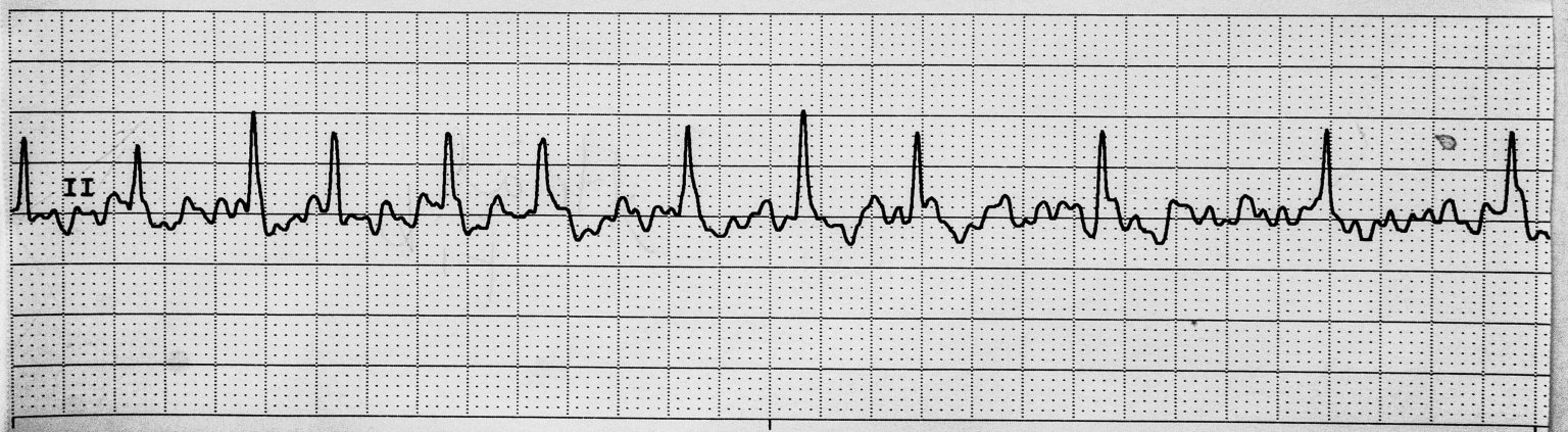 7.4 ECG Patterns and Dysrhythmias – Nursing Advanced Skills