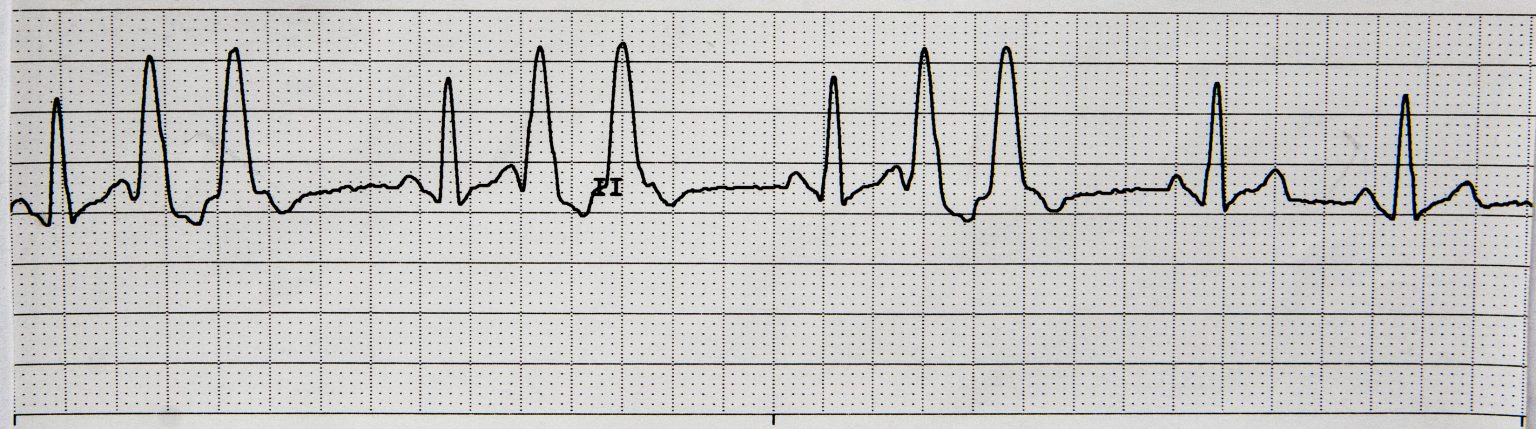 7.4 ECG Patterns and Dysrhythmias – Nursing Advanced Skills