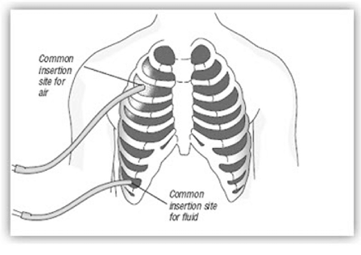 Illustration of Common Chest Tubes Placement Sites