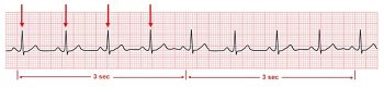 7.3 A Systematic Approach to Interpreting an ECG – Nursing Advanced Skills