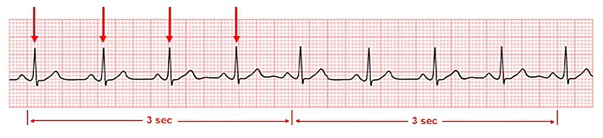 Image of a ecg strip, with arrows, to demonstrate Calculating the Ventricular Rate by Counting the R Waves in a 6-Second Strip