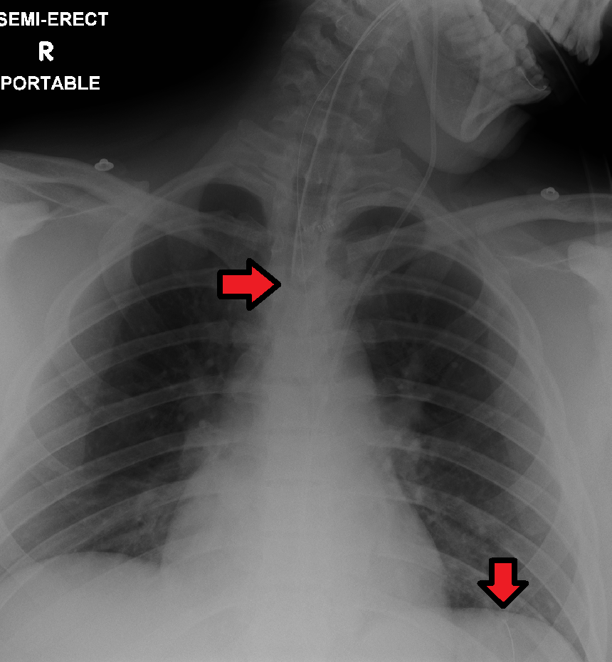 X ray image showing Placement Verification of NG tube