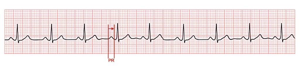 Image of an ecg strip, with labels demonstrating measuring the PR interval