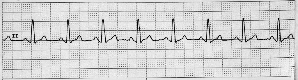 Image showing a normal sinus rhythm on an ECG