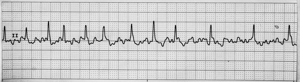 Image showing a rhythm pattern on a ECG