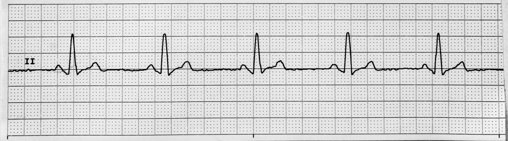 Image showing Sinus Bradycardia on an ECG