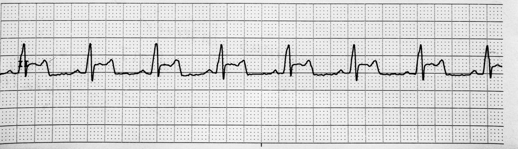 Figure showing ST Elevation on an ECG