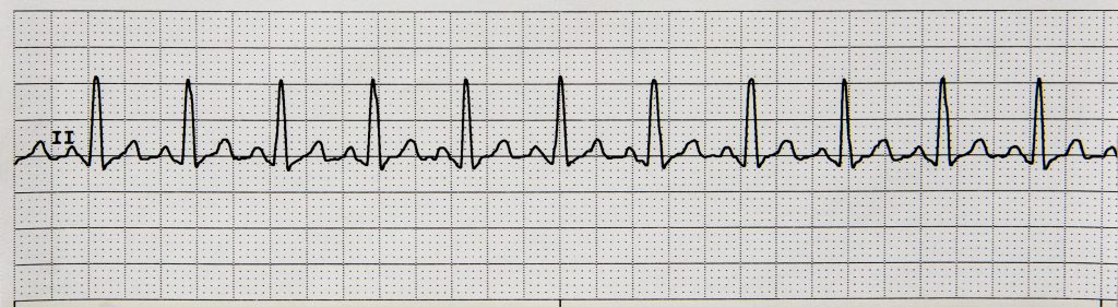 Image showing Sinus Tachycardia on an ECG