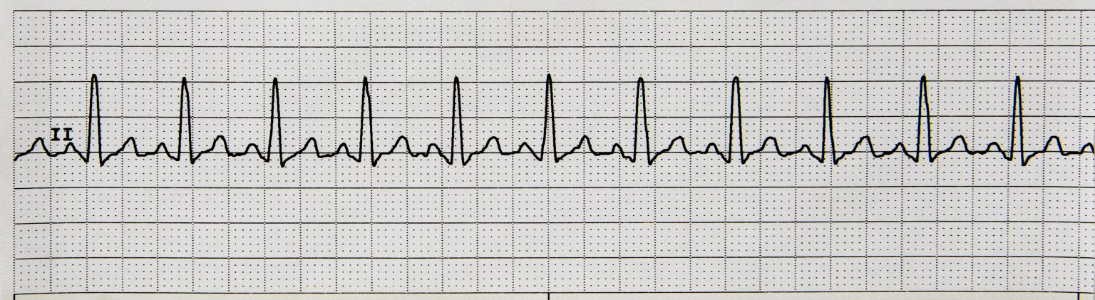 7.4 ECG Patterns and Dysrhythmias – Nursing Advanced Skills