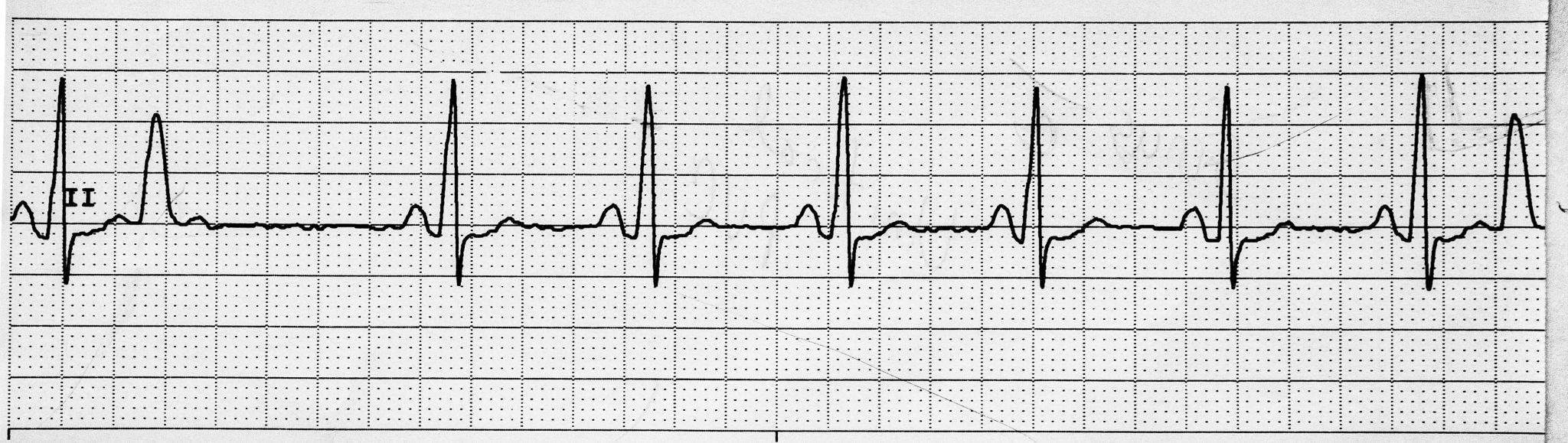 7.4 ECG Patterns and Dysrhythmias – Nursing Advanced Skills