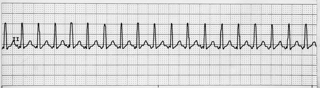 Image showing Supraventricular Tachycardia on a ECG