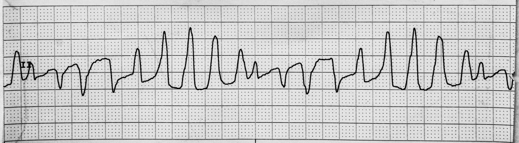 Image showing Torsades de Pointes on an ECG